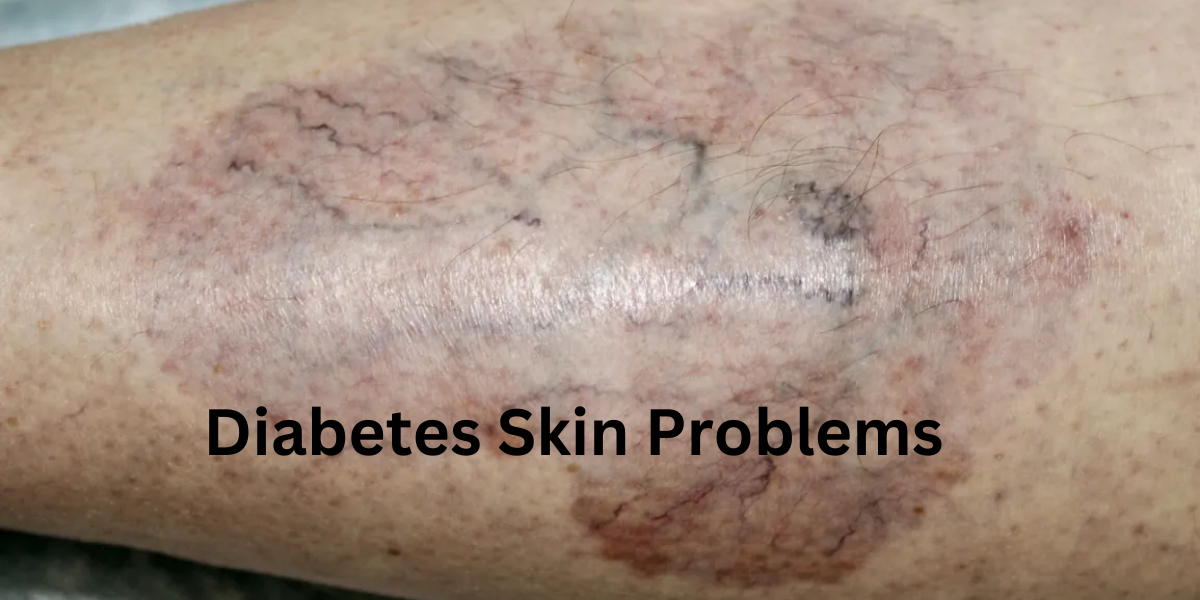 diabetes skin problems